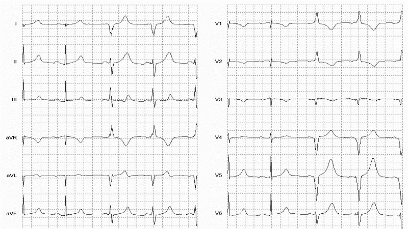 Ventricular Paced (RBB morphology) 62 BPM